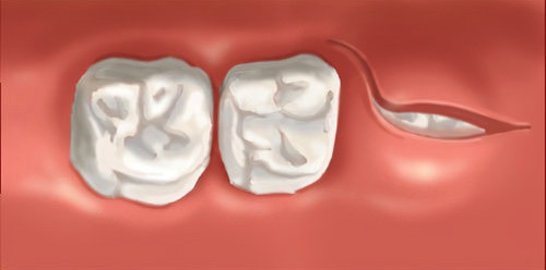 Cabinet orthodontiste Guilherand Granges dents de sagesse